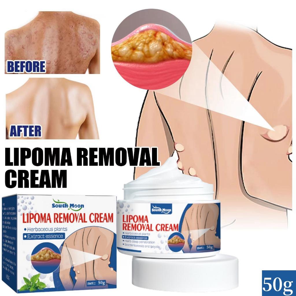 Natural Lipoma Removal Cream | Free Home Delivery